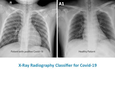 X-Ray Radiography Classifier for Covid-19