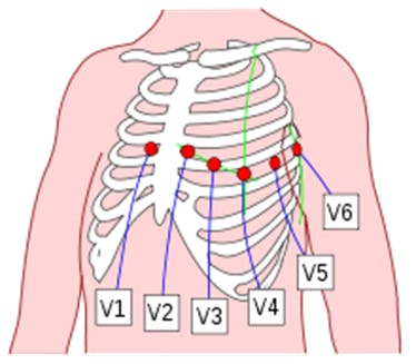 Figure 17. Placement of 6 chest leads.