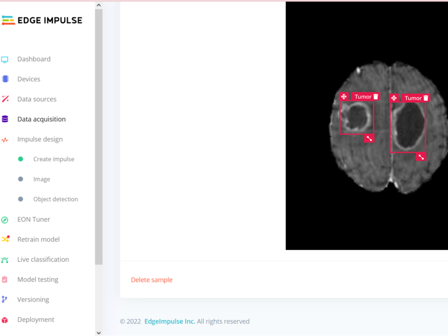 Human brain tumor detection for FOMO