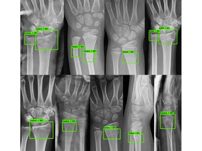 GEN AI-Driven Automation for Wrist X-ray Report Generation