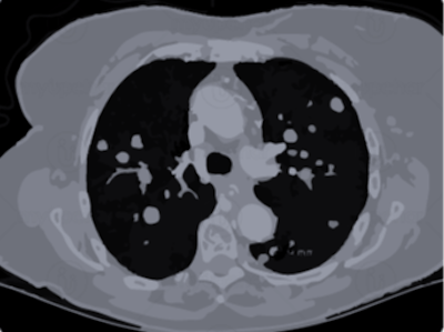 Early Lung Cancer detection using Deep learning