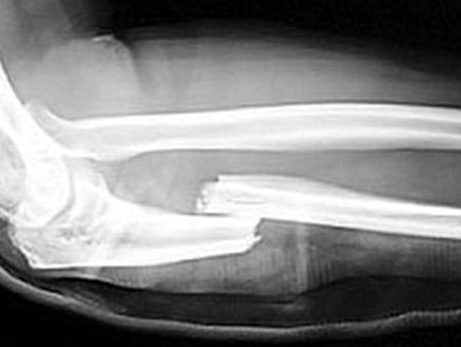 Using Walabot for detecting broken bones in extremities