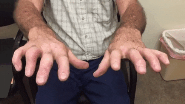 Hand tremors in individuals affected by Parkinsons (https://fscl01.fonpit.de/userfiles/7235249/image/trump/Hand-tremors-2.gif)