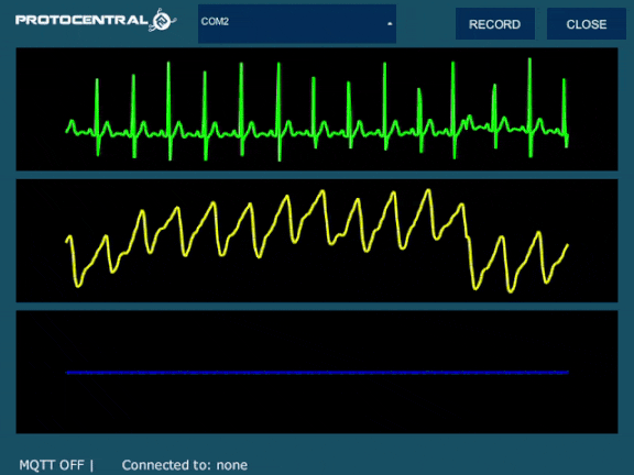 Here is the final output of the PPG and ECG in synchronous display